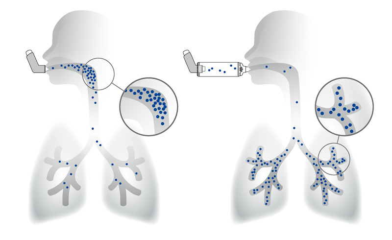inhalationstherapie inhalierhilfe