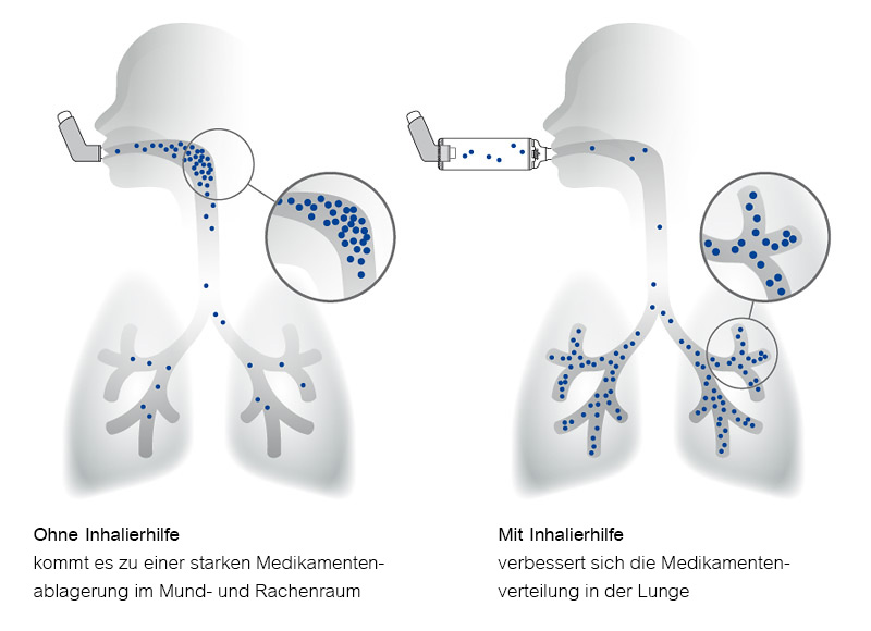 inhalationstherapie mit inhalierhilfe