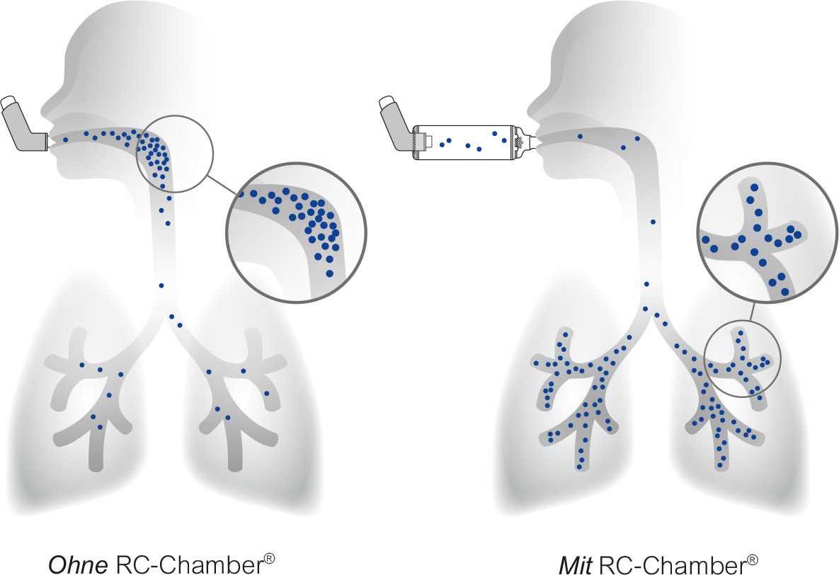 Medikamentenverteilung ohne und mit RC-Chamber®